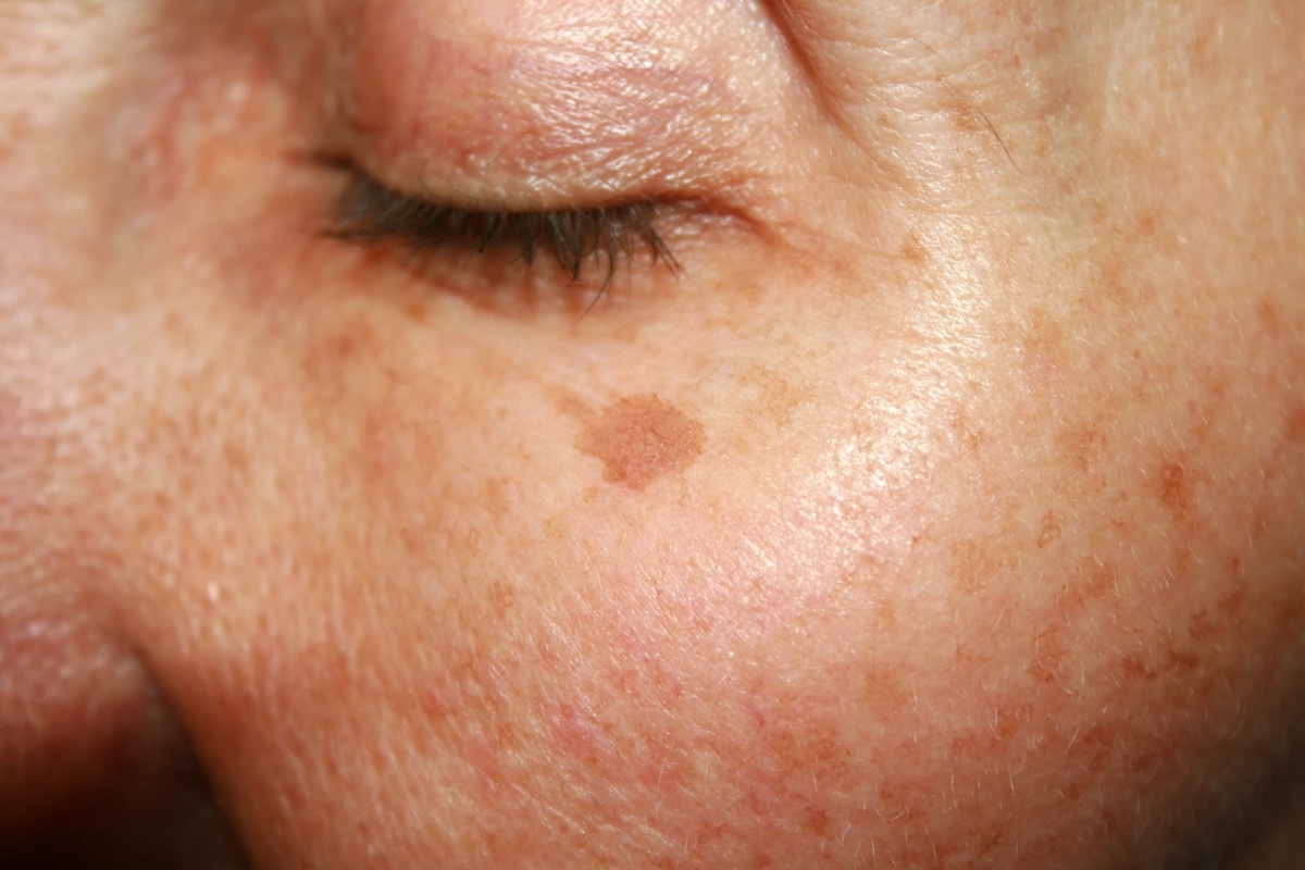 skin spot on old woman's face, health questions after 40