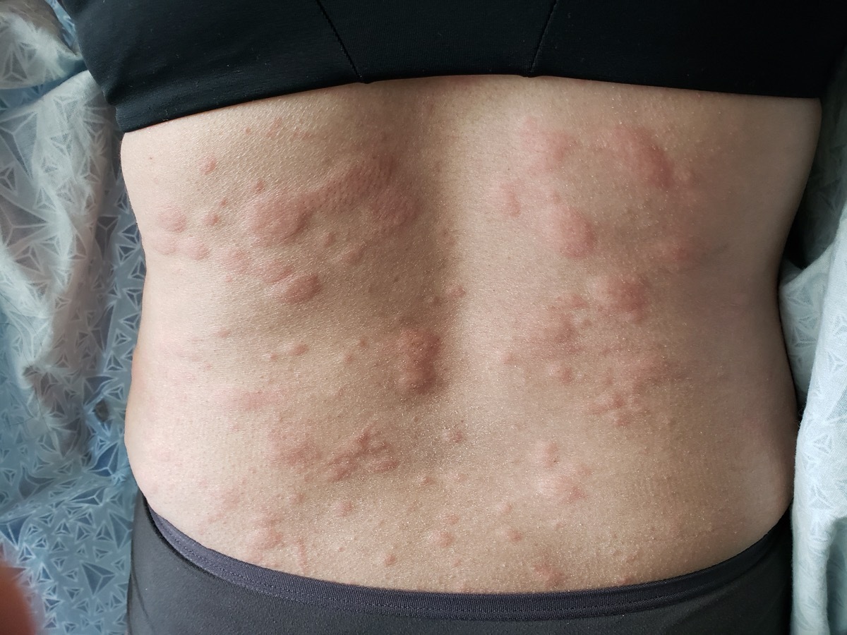 Hive-like rash