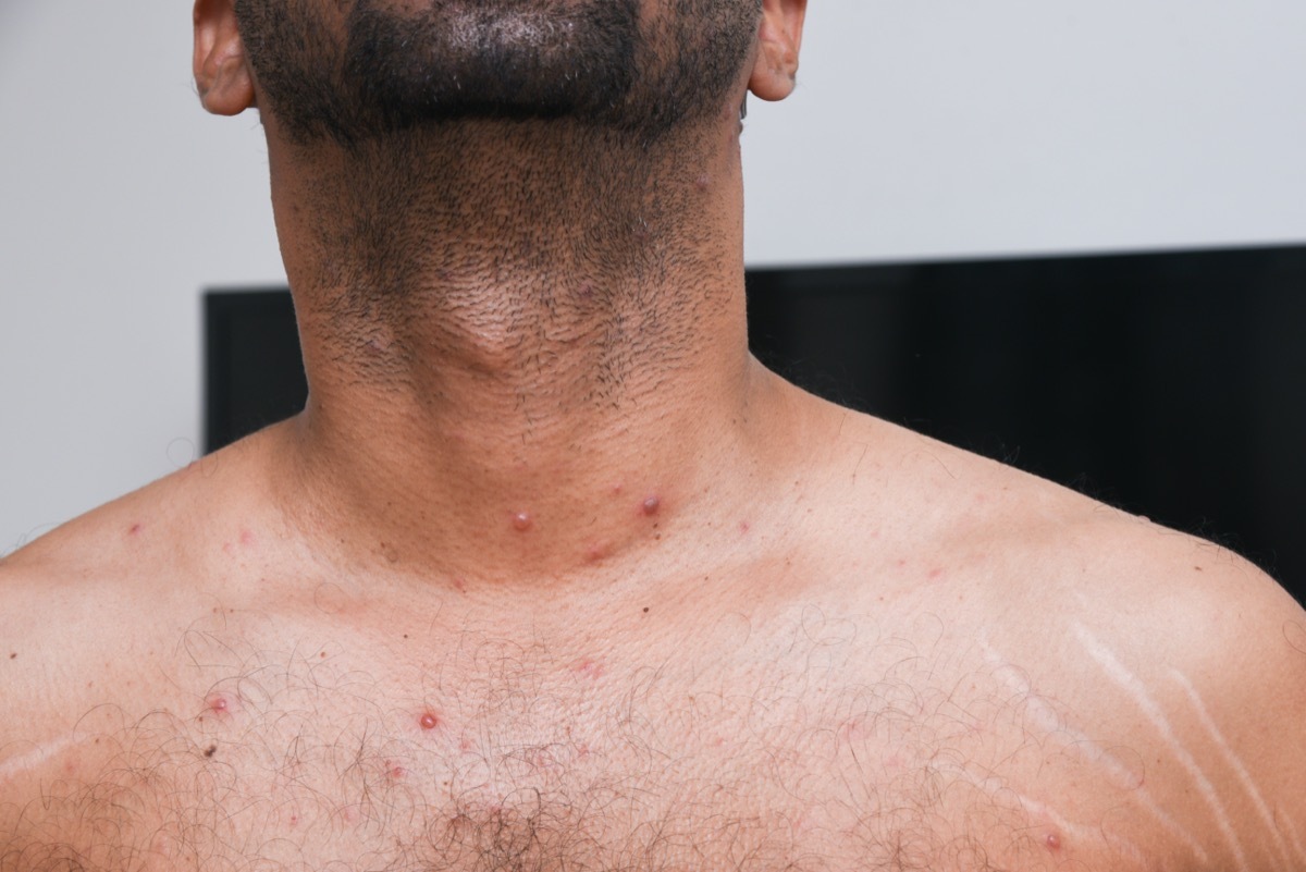 man with Chicken pox rash