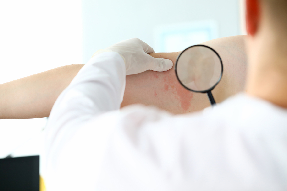 Dermatologist examines a red rash on a patient's skin