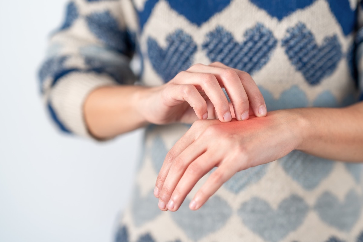 Young woman scratching her itchy hand. Concept skin problem, allergy and dermatology